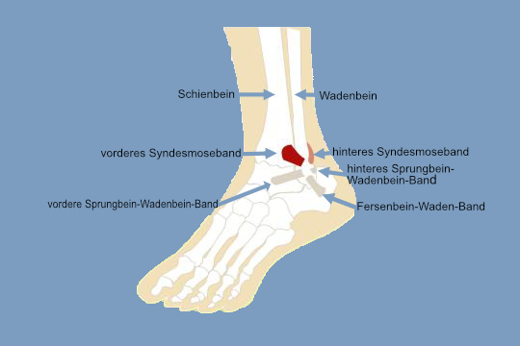DWO-WS-Syndesmoseband-Reus-Aufm