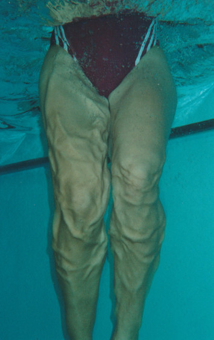 Aquatraining, Aquatherapie bei Margot Zeitvogel-Schönthier, Massagewirkung nach Landung vom Hocksprung Aquatraining, Aquatherapie bei Margot Zeitvogel-Schönthier, Massagewirkung nach Landung vom Hocksprung