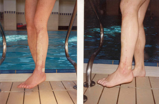 Aquatraining, Aquatherapie Patient bei Margot Zeitvogel-Schönthier mit Trümmerfraktur