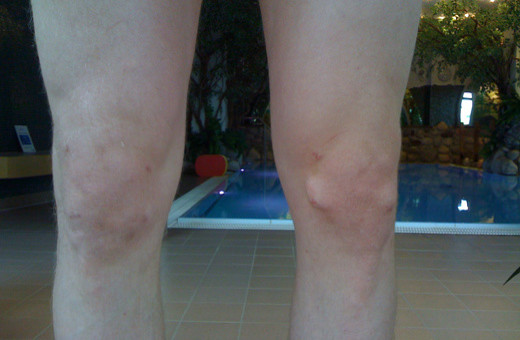 Zustand nach mehreren Kreuzbandoperationen, Patient von Margot Zeitvogel-Schönthier zur Aquatherapie